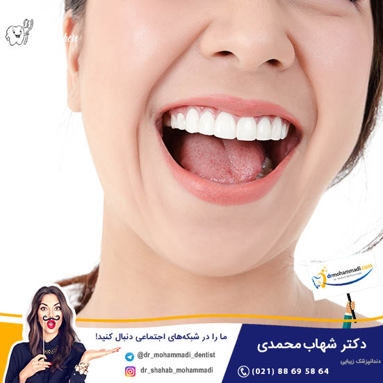 آشنایی با نکته های مهم انتخاب رنگ و سایه مناسب ونیر - کلینیک دندانپزشکی دکتر شهاب محمدی